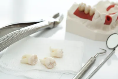 How Much Does Wisdom Tooth Removal Cost?