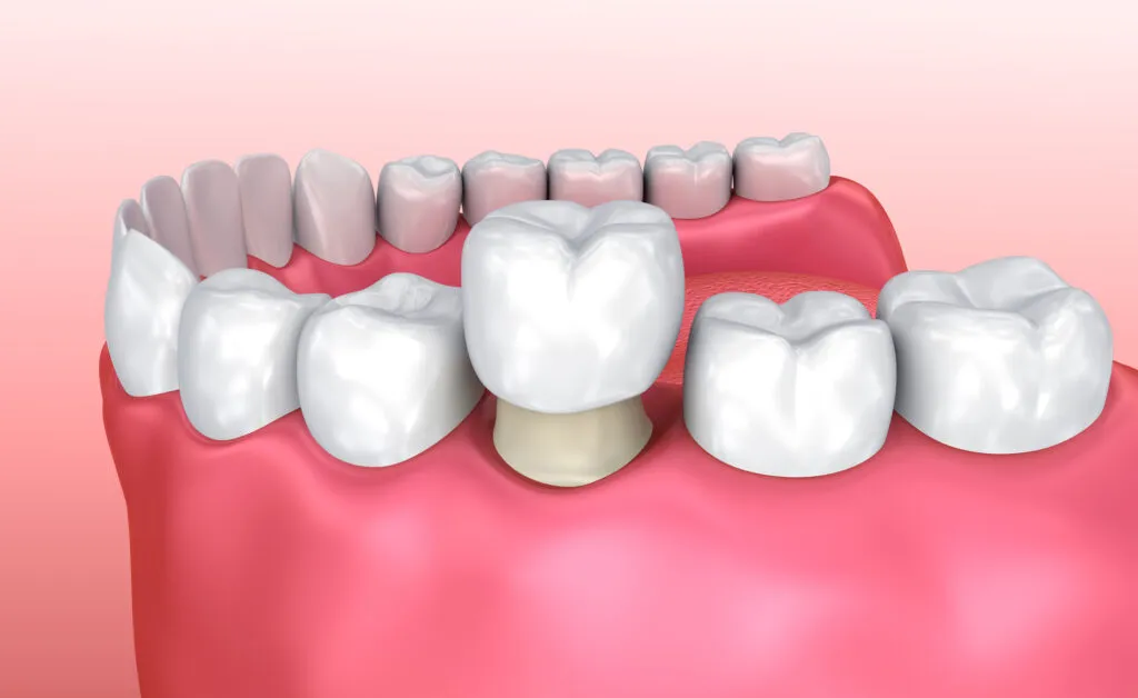 3D illustration of a Temporary Dental Crown being installed on to teeth