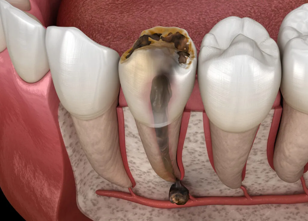 3D illustration of a severe tooth decay