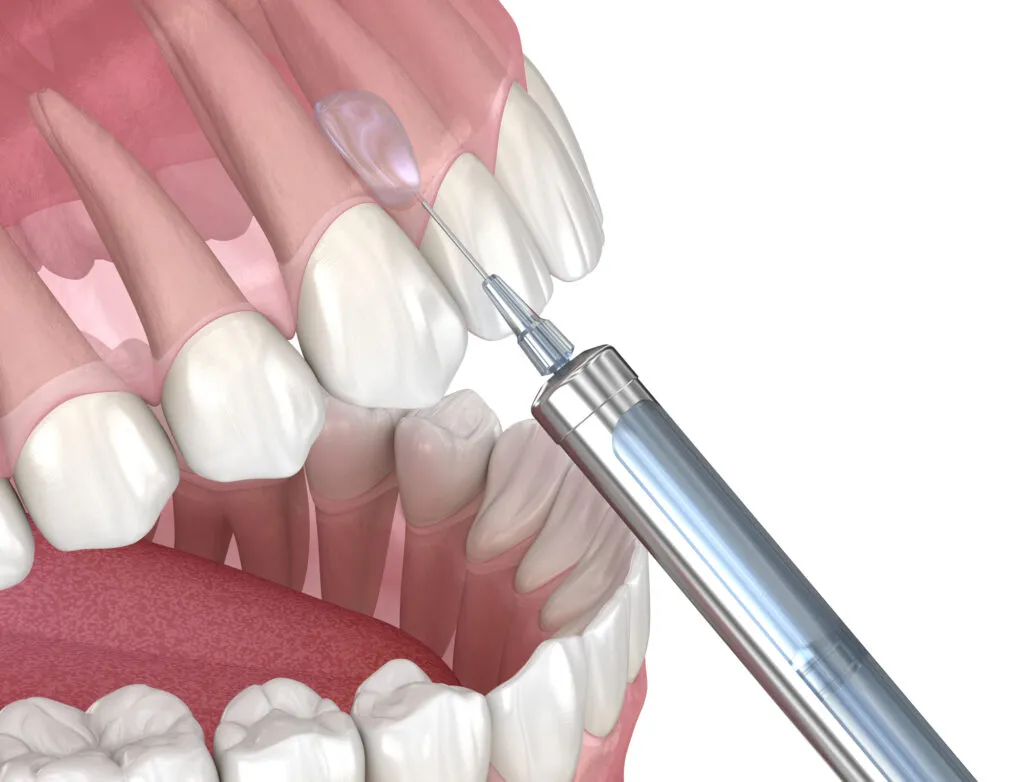 3D illustration of local anesthesia injected into the gums for a dental procedure