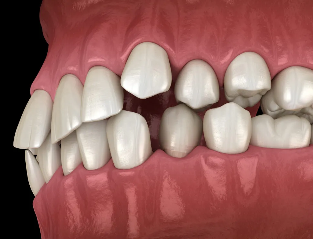3D render illustration of an abnormal crooked teeth position