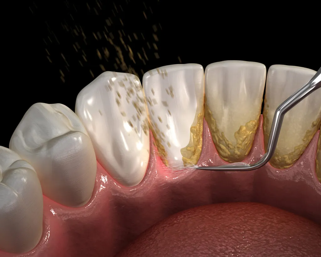 3D render of a dental calculus removal