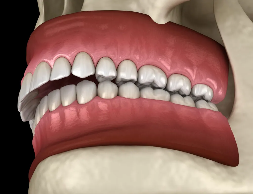 3D render of an Overbite dental occlusion or Malocclusion of teeth
