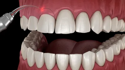 Gingivectomy: Cost, Procedure, and When It's Necessary