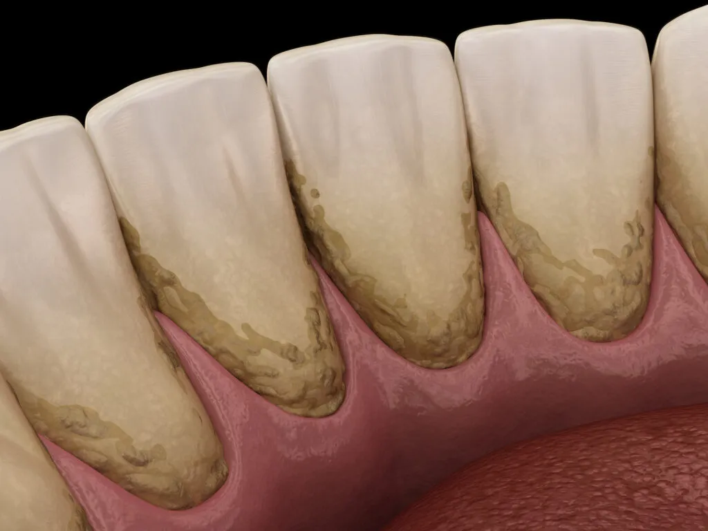 3D render of tartar and bactrail tooth plaque on teeth of lower jaw