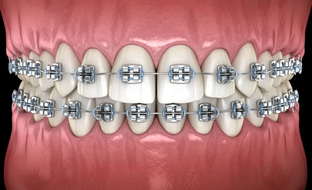 3D render of teeth with metal braces in gums