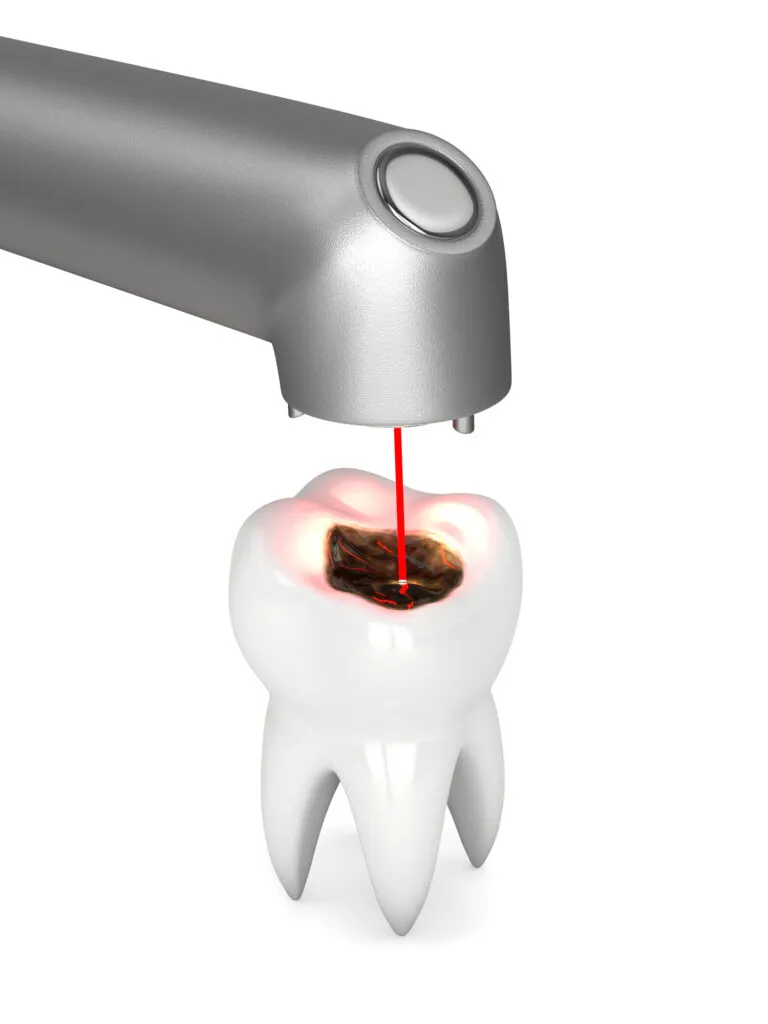 3d illustration of a procedue using denal laser to treat dental caries