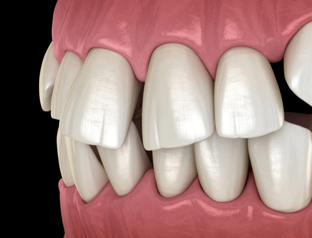 3d illustration of an abnormal teeth position or a buck teeth due to excessive overjet condition