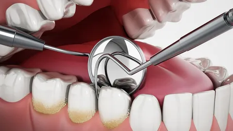 What Is Plaque and How Do I Remove It?