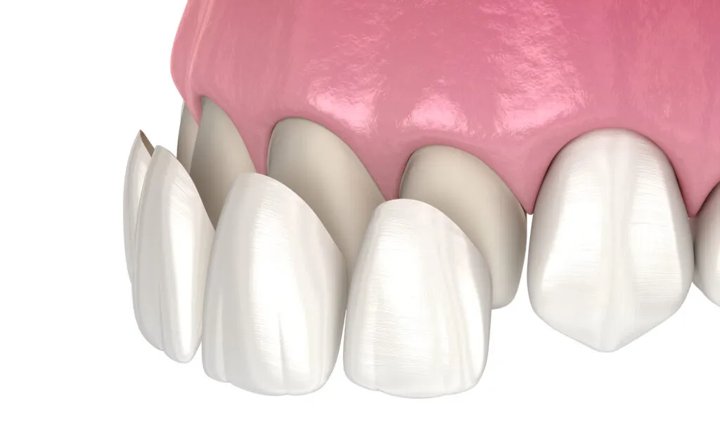 3d illustration of no prep veneers being installed into the teeth