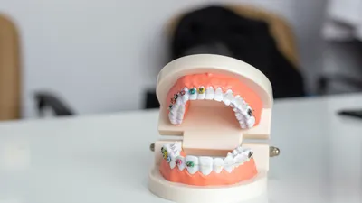 Ceramic Braces: Cost, Pros, Cons, and Alternatives