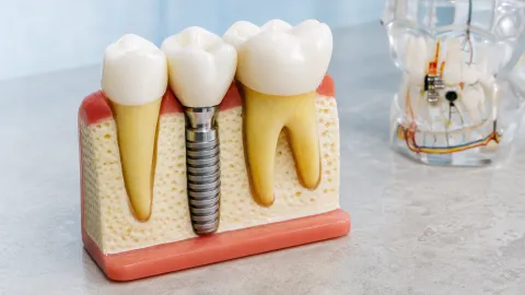 What is a Donor Tooth Transplant?