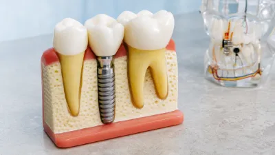 What is a Single Tooth Implant?