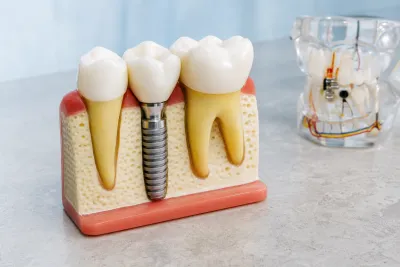 What is a Single Tooth Implant?