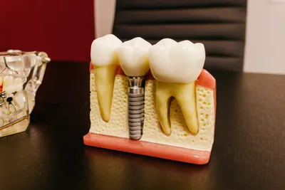 What is a Single Tooth Implant?