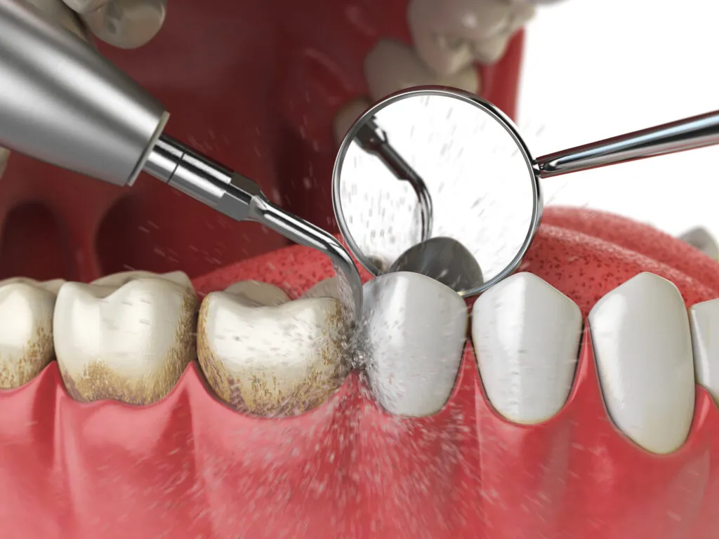 3d render of a professional ultrasonic teeth cleaning