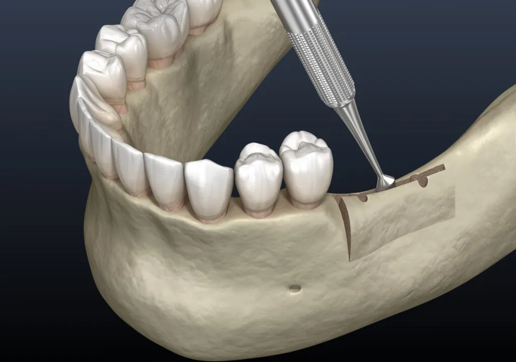 3d render of alveoloplasty being performed on alveolar ridge or bone of the lower jaw