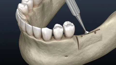 What Is An Alveoloplasty?