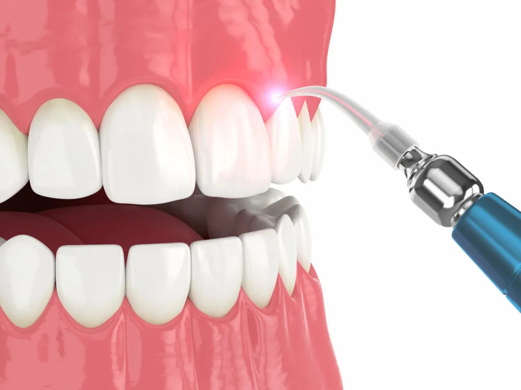 3d render of dental diode laser used to treat gum disease