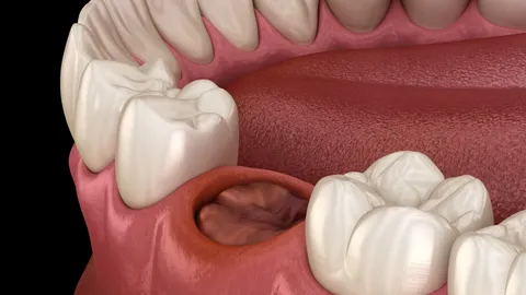 Dry Sockets After Wisdom Tooth Removal
