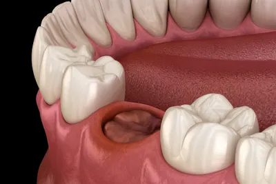 Dry Sockets After Wisdom Tooth Removal