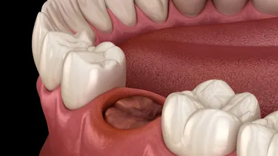 Dry Sockets After Wisdom Tooth Removal