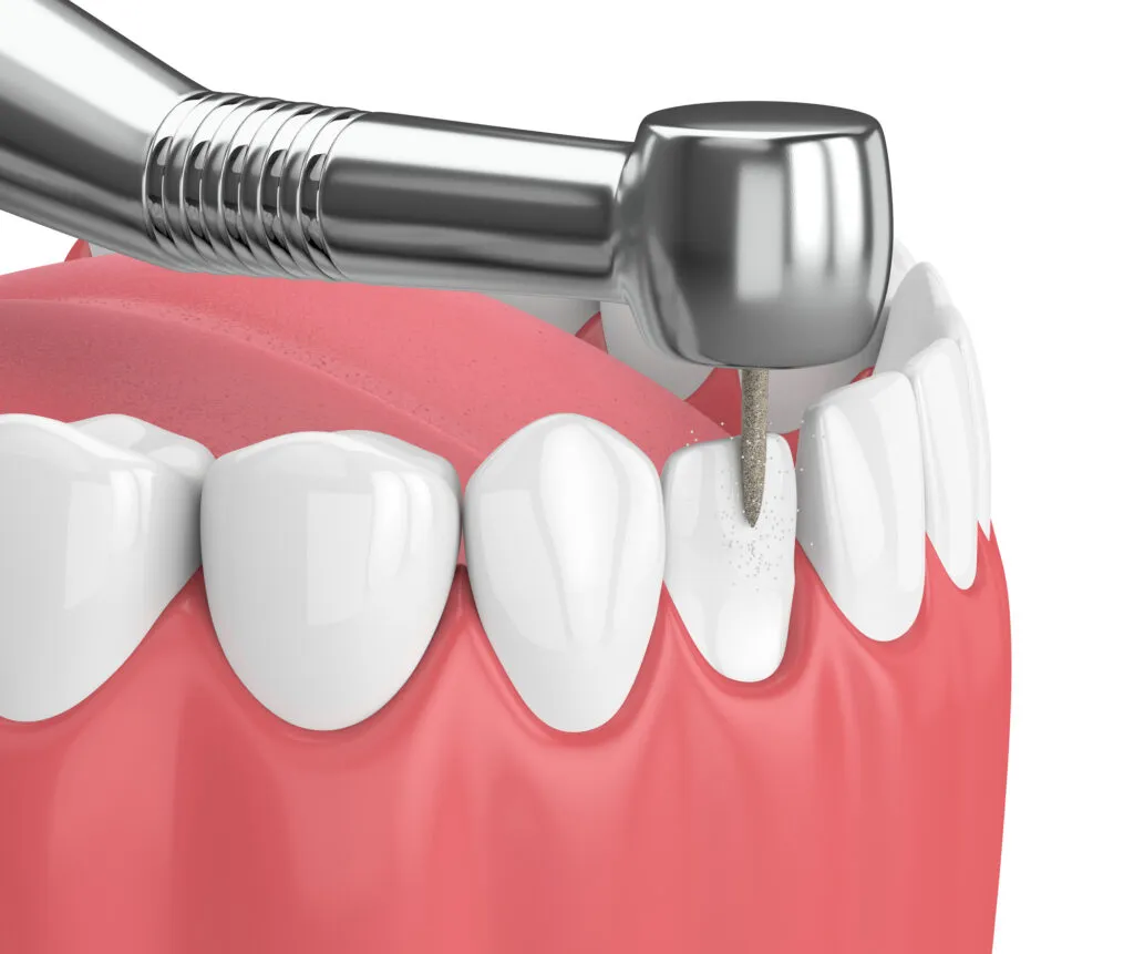 3d render of jaw with dental handpiece and drill for teeth contouring or reshaping