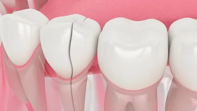 What Are the Different Types of Tooth Files?