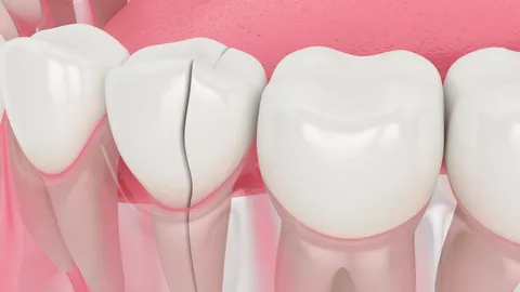 Cracked Teeth: 5 Types of Tooth Fractures