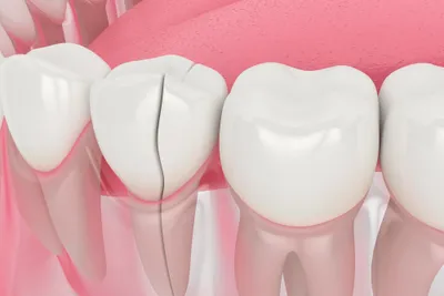 How to Identify and Treat a Cracked Tooth