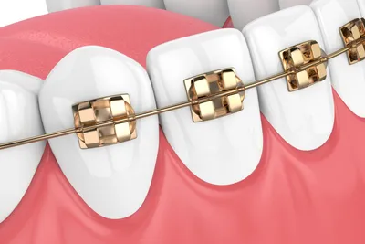 Gold Braces: Pros, Cons & Costs