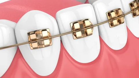 Gold Braces: Pros, Cons & Costs