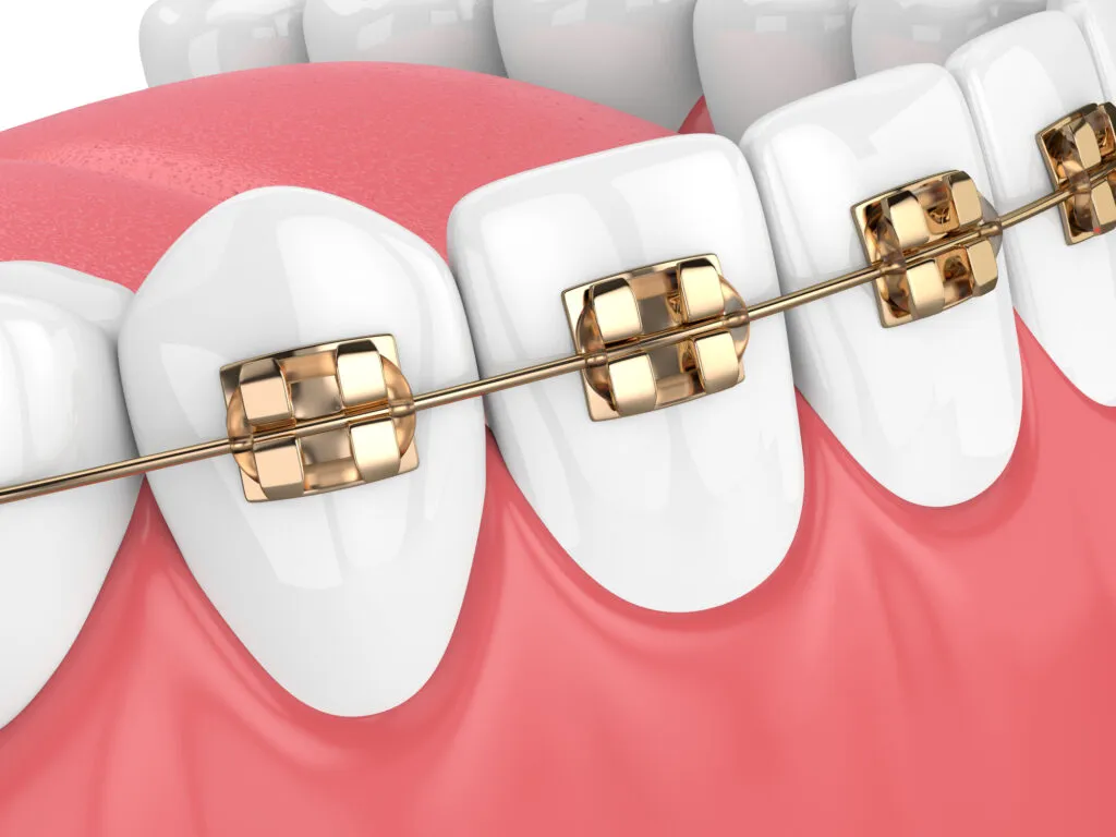3d render of jaw with teeth and golden orthodontic braces