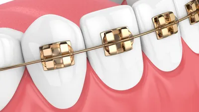 Gold Braces: Pros, Cons & Costs