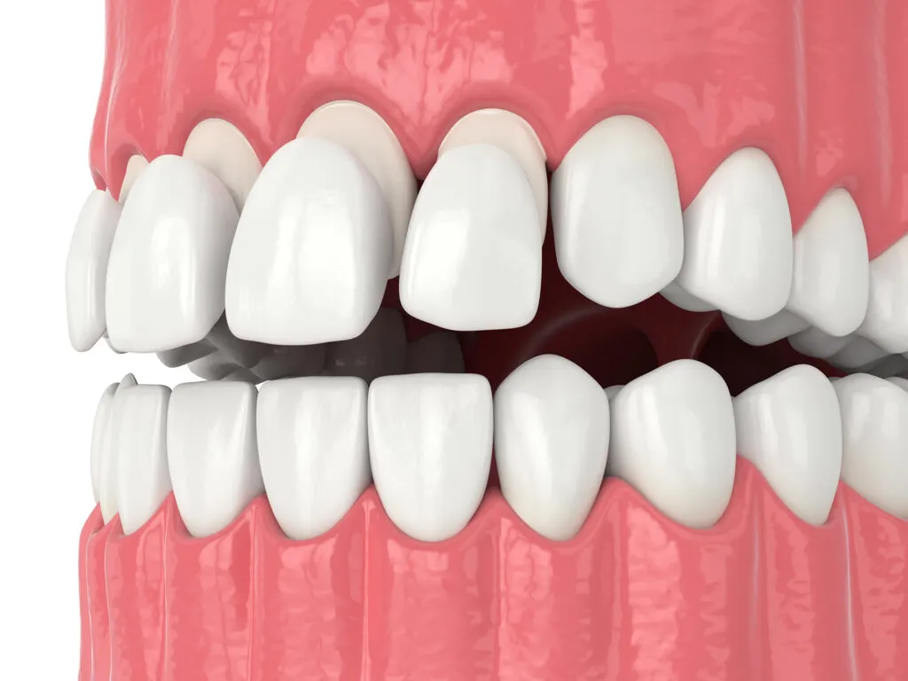 3d render of jaw with teethand upper composite veneers
