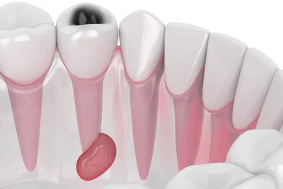Dental Abscess: Causes, Symptoms, Treatment, and Prevention