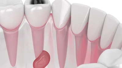 Dental Abscess: Identifying and Treating It at Home