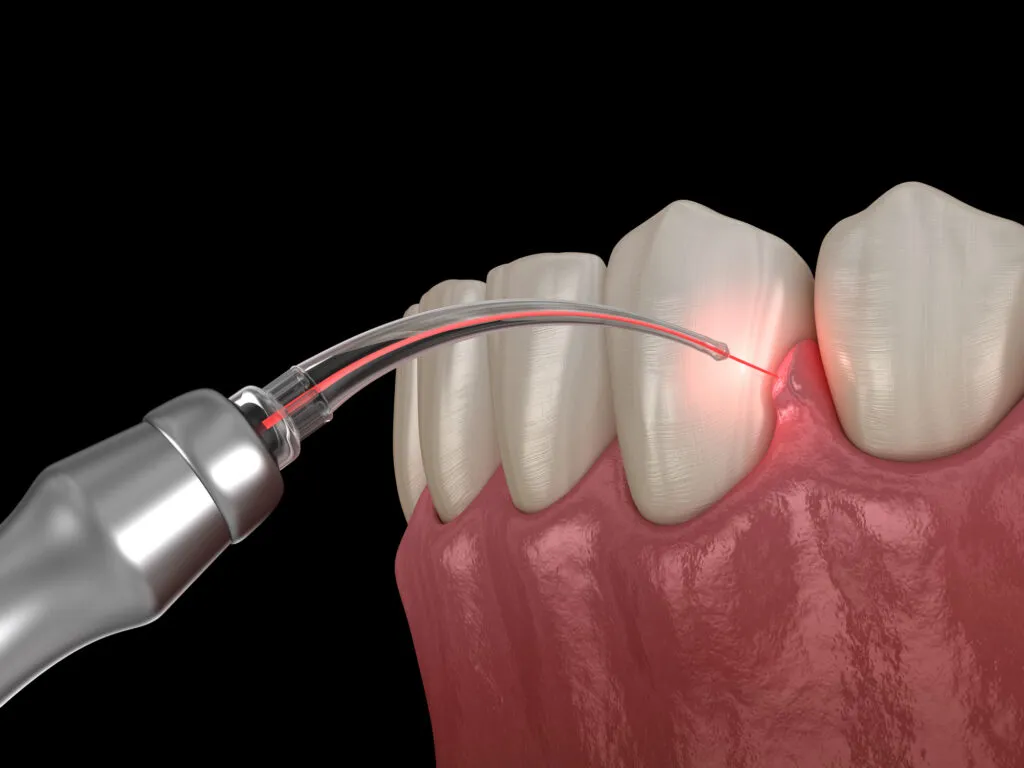 3d render of laser frenectomy or gum correction surgery with laser