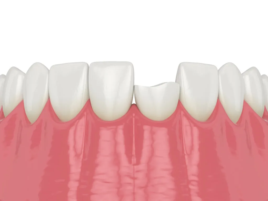 3d render of lower jaw with broken or chipped tooth