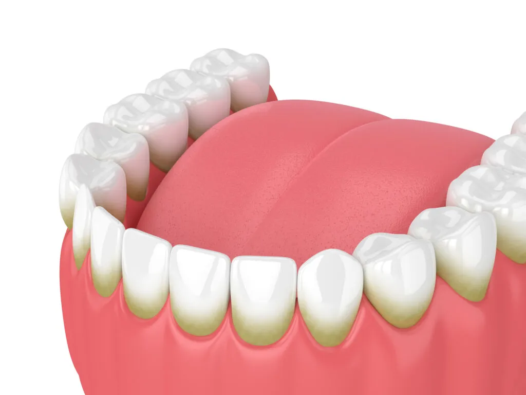 3d render of teeth with plaque and tartar over white background