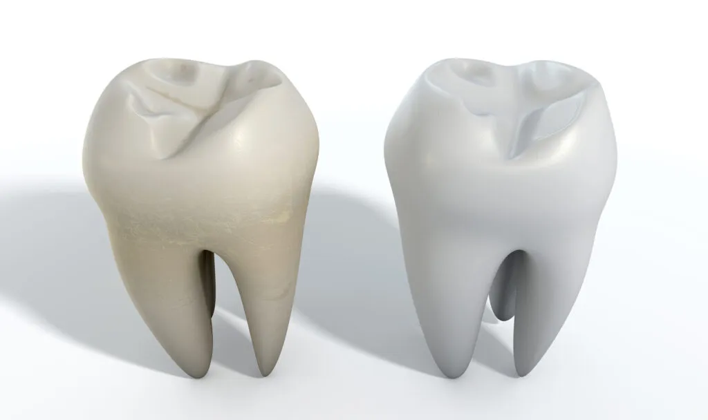 3d tooth comparisons of a yellowish extrinsic tooth stain vs a healthy white tooth