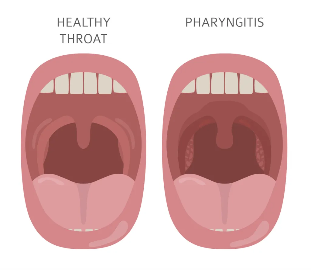 A comparative illustration of a healthy throat vs a throat suffering pharyngitis