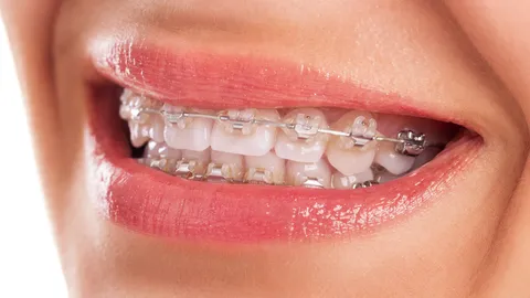 How to Whiten Teeth With Braces