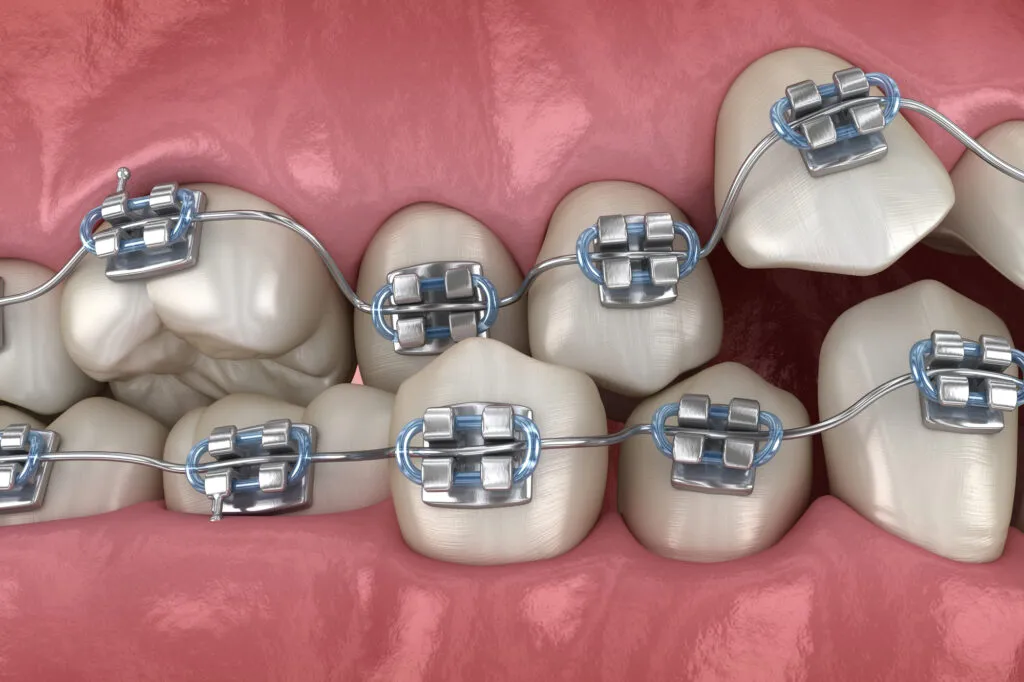 Close-up 3D illustration of teeth with orthodontic braces, showing metal brackets and wires on an upper dental arch.