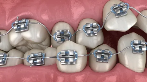 Malocclusion of the Teeth: Types, Causes & Treatment