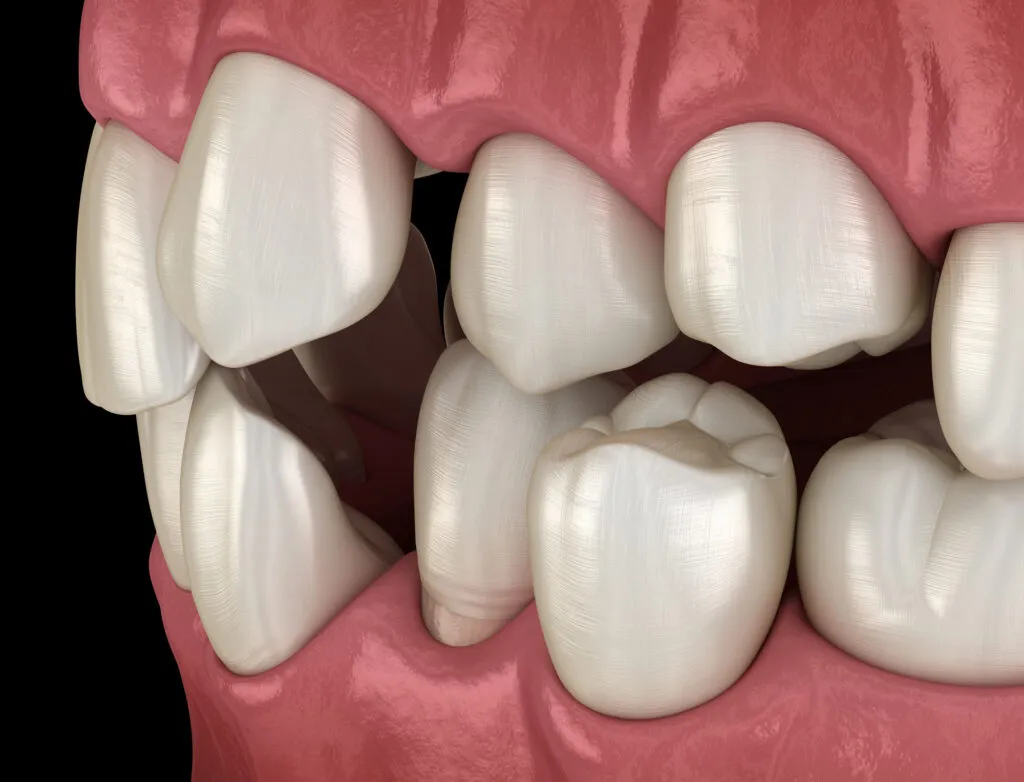 Abnormal teeth position or a snaggle tooth 3d render