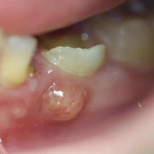 Dental Abscess