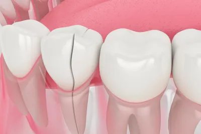 How Much Does it Cost to Repair a Chipped Tooth?
