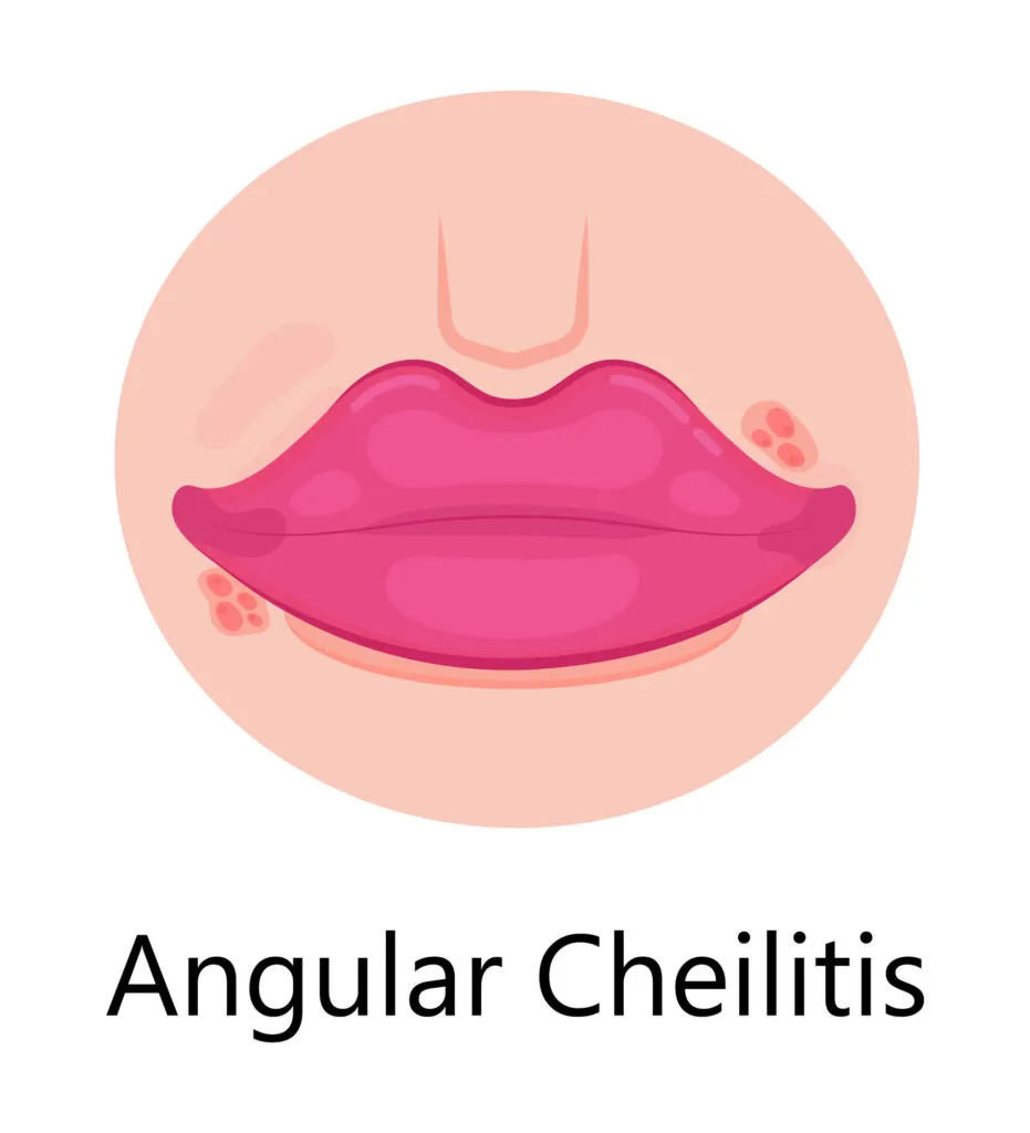 Angular Cheilitis