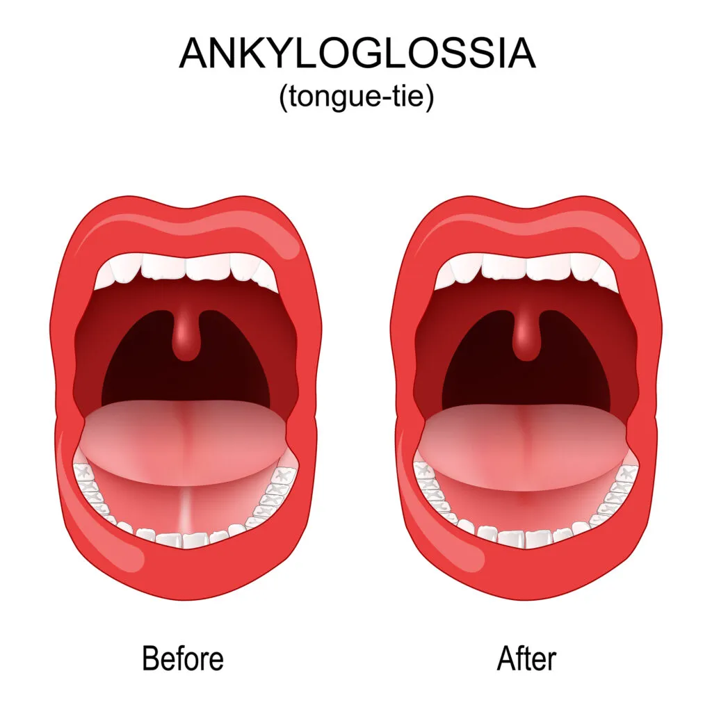 Ankyloglossia. tongue tie. congenital oral anomaly